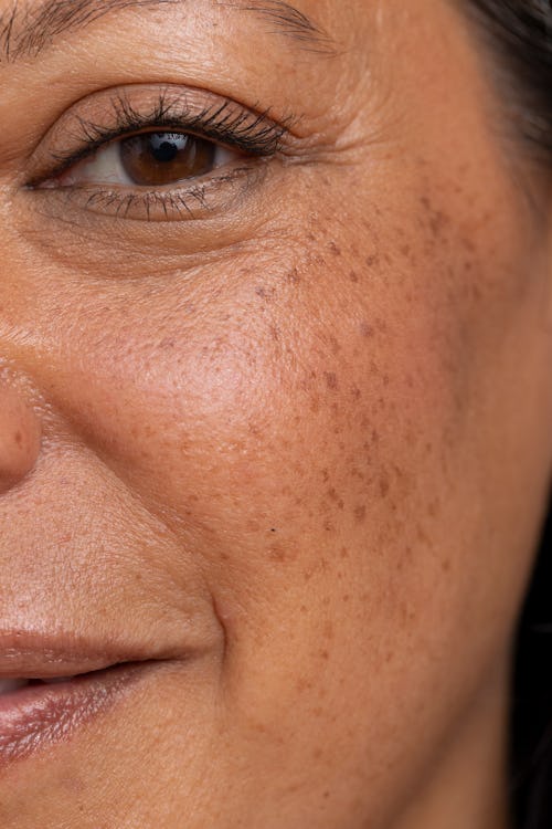 PDGF 눈 밑 필러가 인기를 끌고 있습니다 - 그 이유는 다음과 같습니다